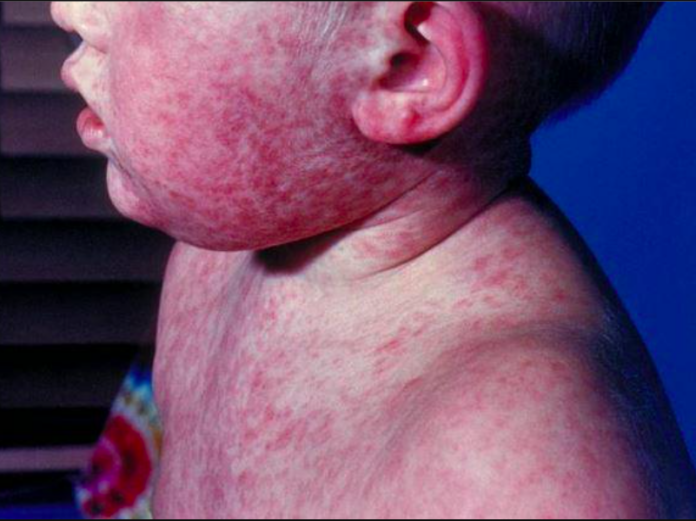 measles